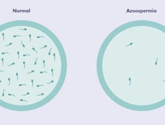 Azoospermia Myths_ What’s True and What’s Not_