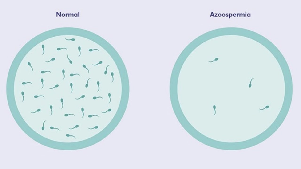 Azoospermia Myths_ What’s True and What’s Not_